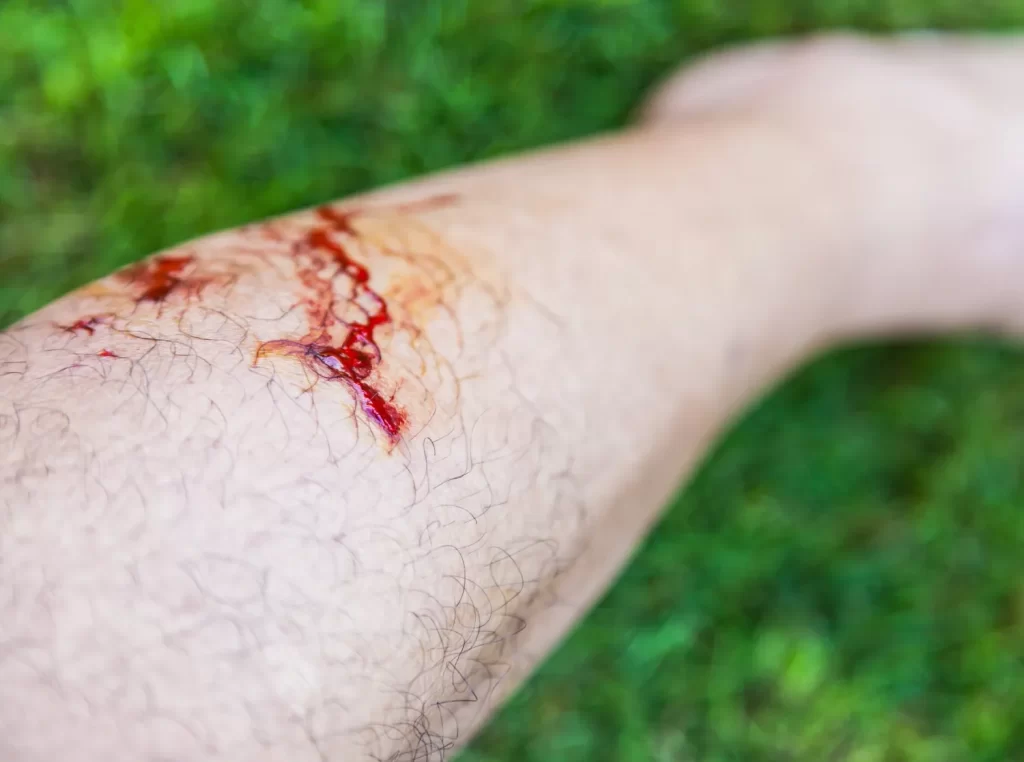 Medina dog bite lawyer